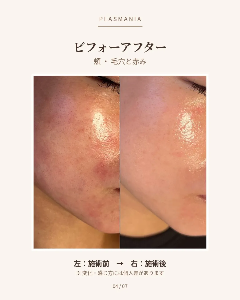 毛穴も、くすみも。