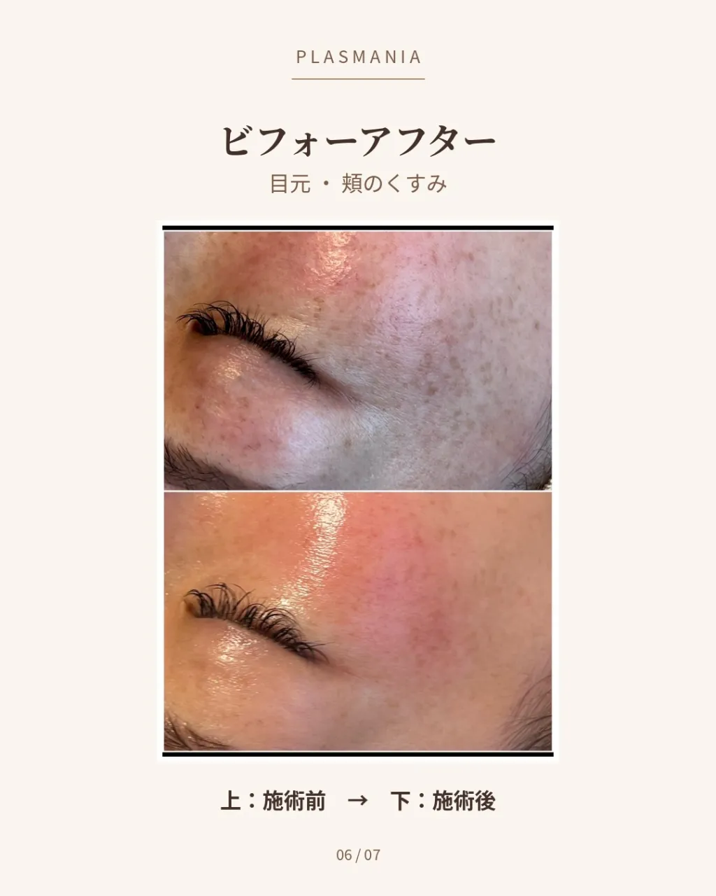 毛穴も、くすみも。